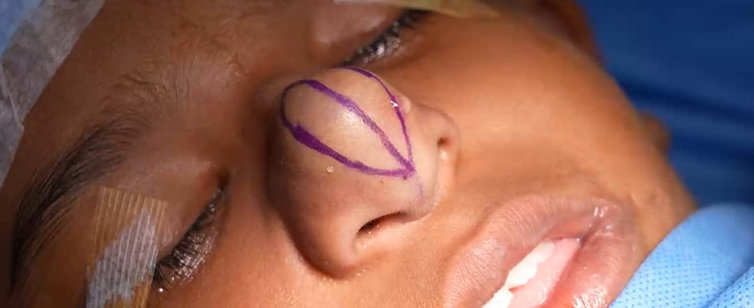 Tumor Removal